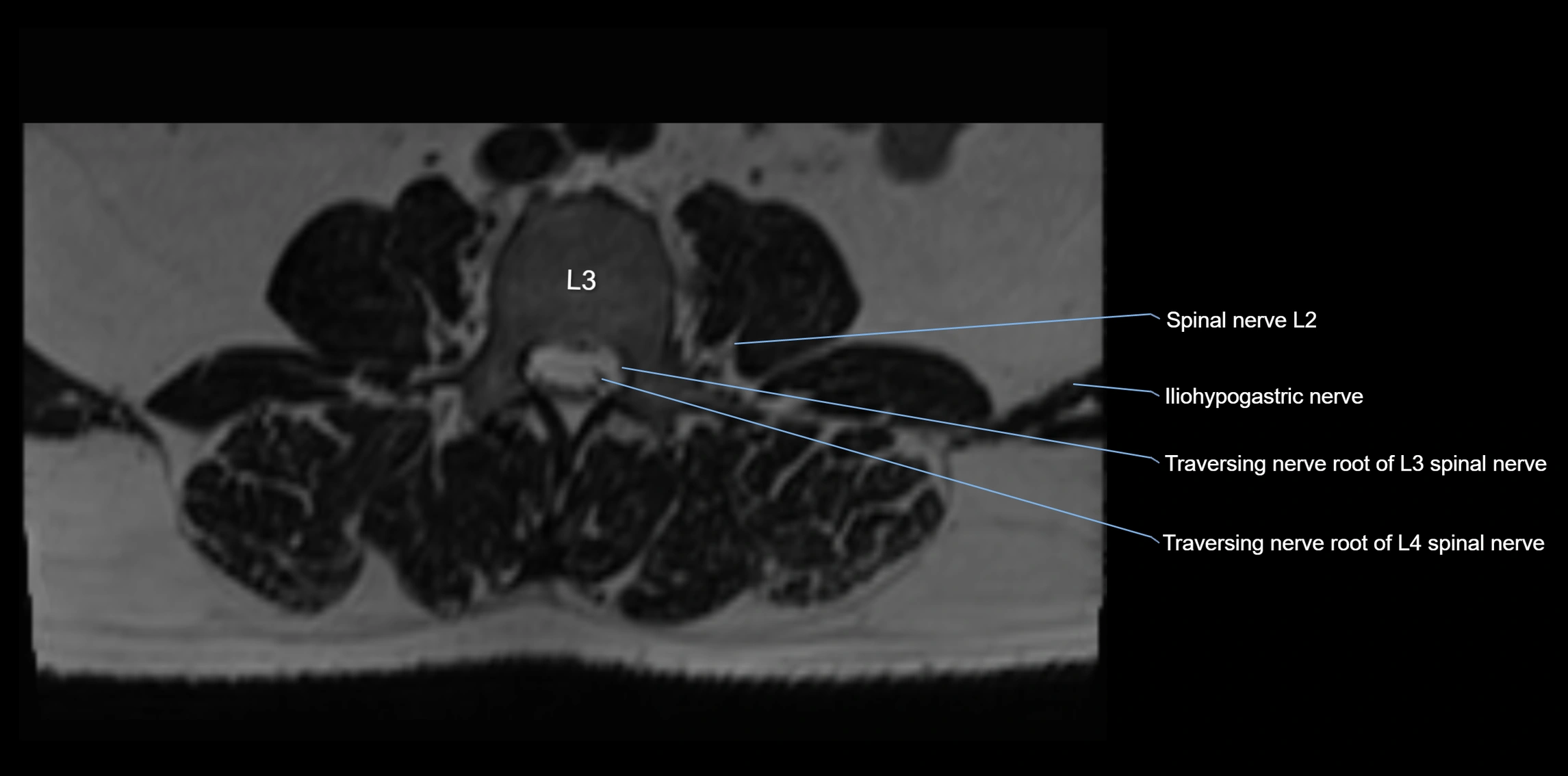 MR lumbosacral plexus axial cross sectional anatomy 3T  radiology  image-img-1008001-00019.webp